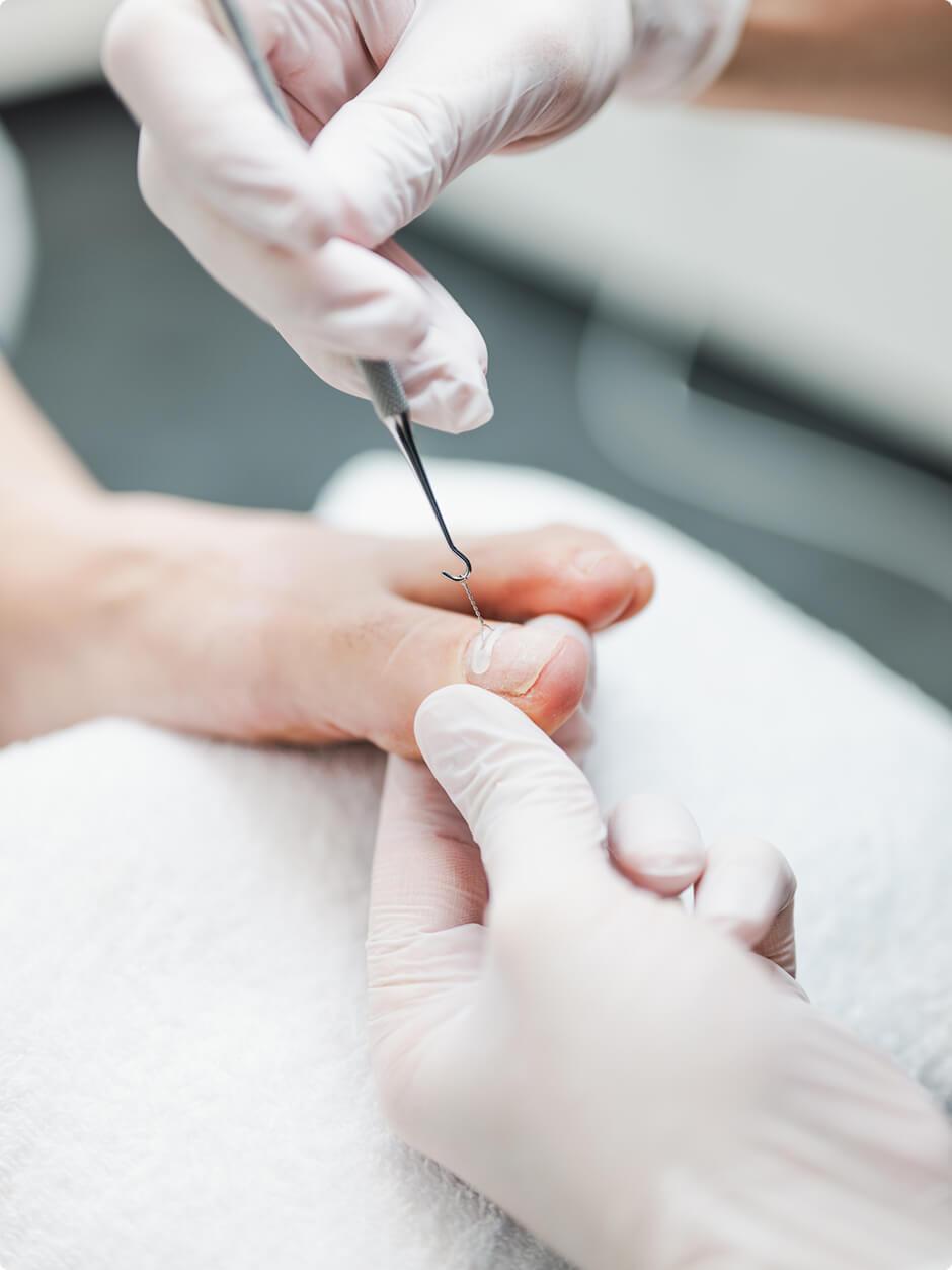 Was sind Nagelkorrekturspangen & eingewachsene Zehennägel?