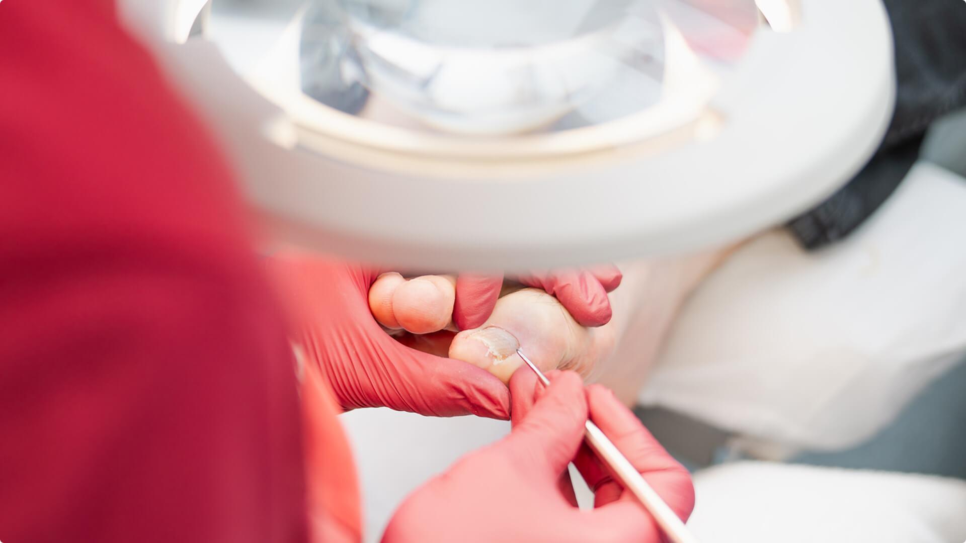 Therapie bei von Pilz infizierten Fußnägeln.