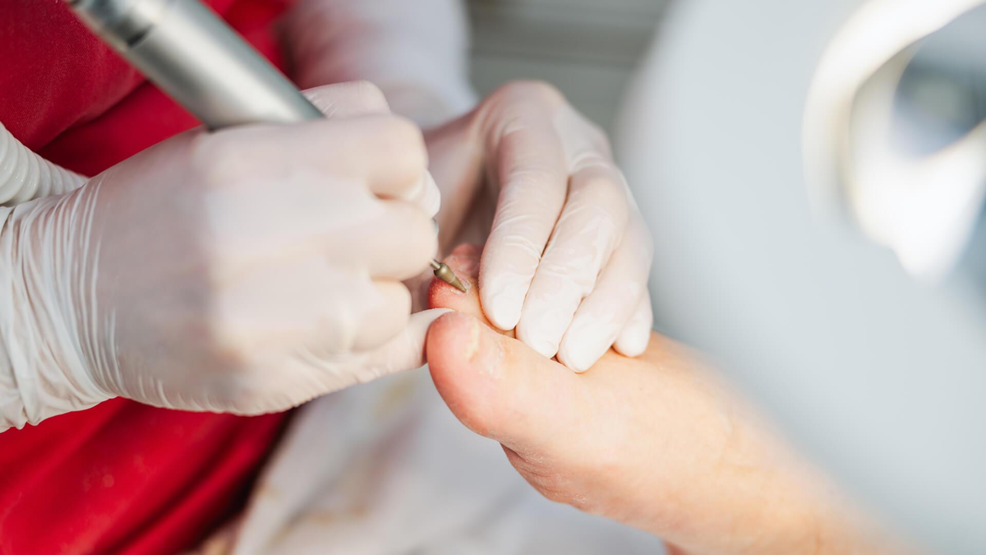 Die podologische Komplexbehandlung umfasst eine vollständige professionelle Pflege beider Füße.