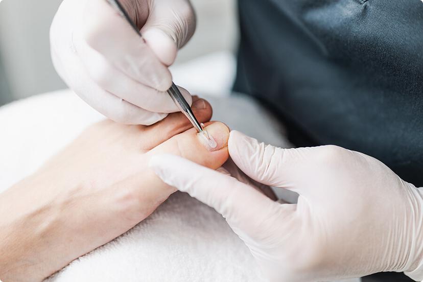 Nagelkorrekturspangen & eingewachsener Zehennagel